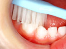 悪い例の歯ブラシの当て方の写真