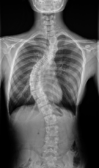 侧弯症术前的X光图像