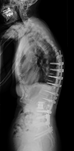椎体骨折術後レントゲン画像
