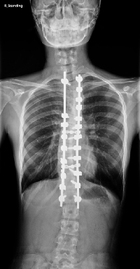 侧弯症术后的X光图像