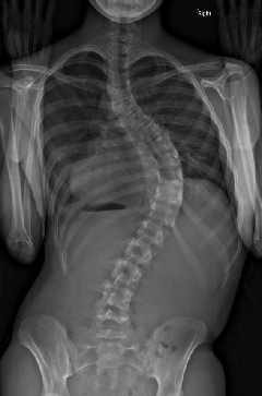 侧弯症术前X光图像