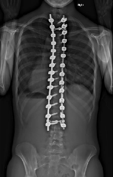 脊柱側凸手術後X光圖片