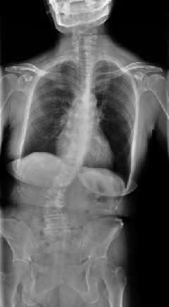脊柱變形手術前X光圖片