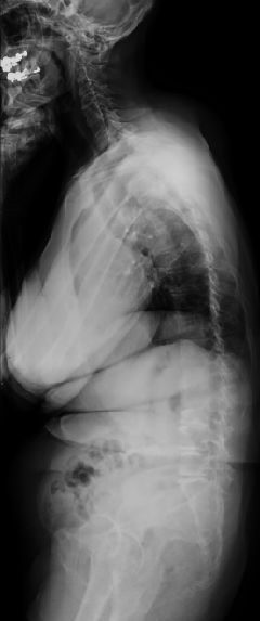 脊柱变形术前X光图像