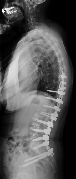 脊柱变形术后X光图像