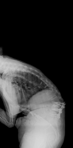 椎體骨折手術前X光圖片