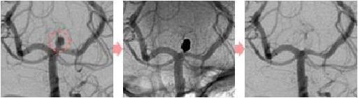 脳動脈瘤塞栓術画像