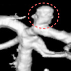 脳動脈瘤画像１