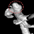 脳動脈瘤画像３