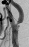 頸動脈ステント留置術前画像