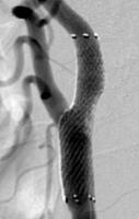 頸動脈ステント留置術後画像