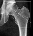 大腿骨測定画像