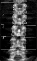 腰椎測定画像