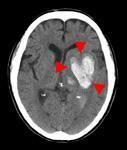 脳内出血のCT画像