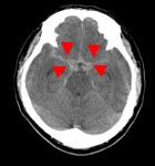 くも膜下出血のCT画像