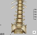 腰椎３ＤCT正面像