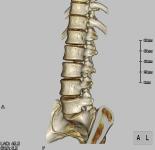 腰椎３ＤCT斜位像