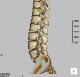 腰椎３ＤCT側面像