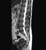 腰椎MR画像