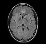 頭部MR画像
