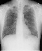胸部X線画像