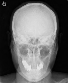 頭部X線画像