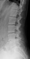 腰椎X線画像