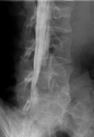 ミエロ右斜位画像