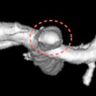 脳動脈瘤画像２