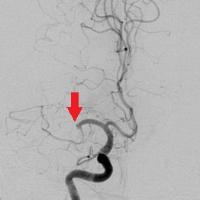 血栓回収療法前