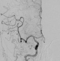 血栓回収療法後