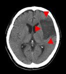 脳梗塞のCT画像
