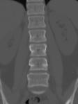 腰椎CT正面像