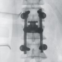 術中腰椎正面画像