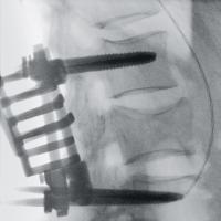 術中腰椎側面画像