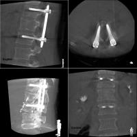 術中腰椎３D画像