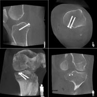 術中膝関節３D画像