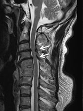 頚椎症性頚髄症に対する椎弓形成術の術前MR画像