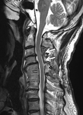 頚椎症性頚髄症に対する椎弓形成術の術後MR画像