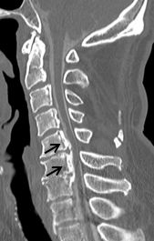 頚椎後縦靭帯骨化症に対する頚椎前方除圧固定術の術前CT画像
