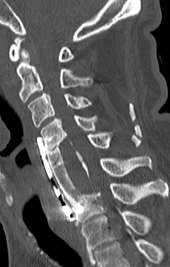 頚椎後縦靭帯骨化症に対する頚椎前方除圧固定術の術後CT画像