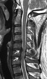 頚椎椎間板ヘルニアに対する頚椎前方除圧固定術の術前画像