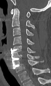 頚椎椎間板ヘルニアに対する頚椎前方除圧固定術の術後画像