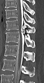 胸椎黄色靭帯骨化症に対する骨化巣切除術の術前CT画像