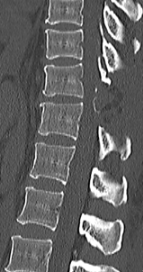胸椎黄色靭帯骨化症に対する骨化巣切除術の術後CT画像