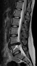 腰椎椎間板ヘルニアの術前MRI画像