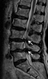 腰部脊柱管狭窄症の術前MRI画像
