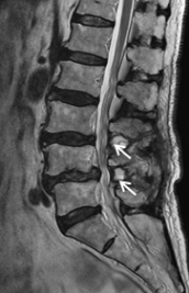腰部脊柱管狭窄症の術後MRI画像