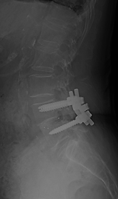 腰椎変性すべり症に対する腰椎後方除圧固定術の術後画像