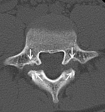 脊椎分離症の術前CT画像１